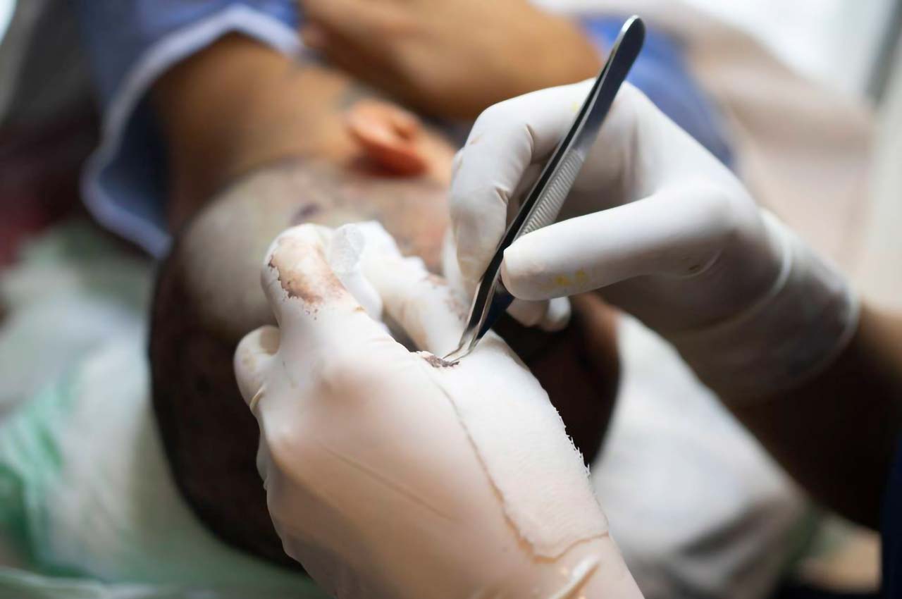 Transplante Capilar FUE: técnica moderna e minimamente invasiva