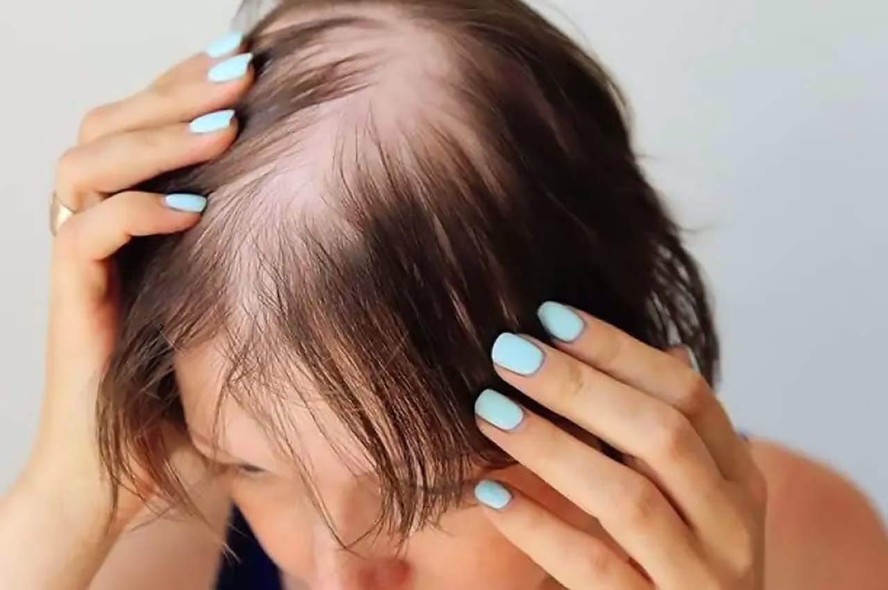 Calvície Feminina: Diferenças em Relação à Masculina e Tratamentos Atuais