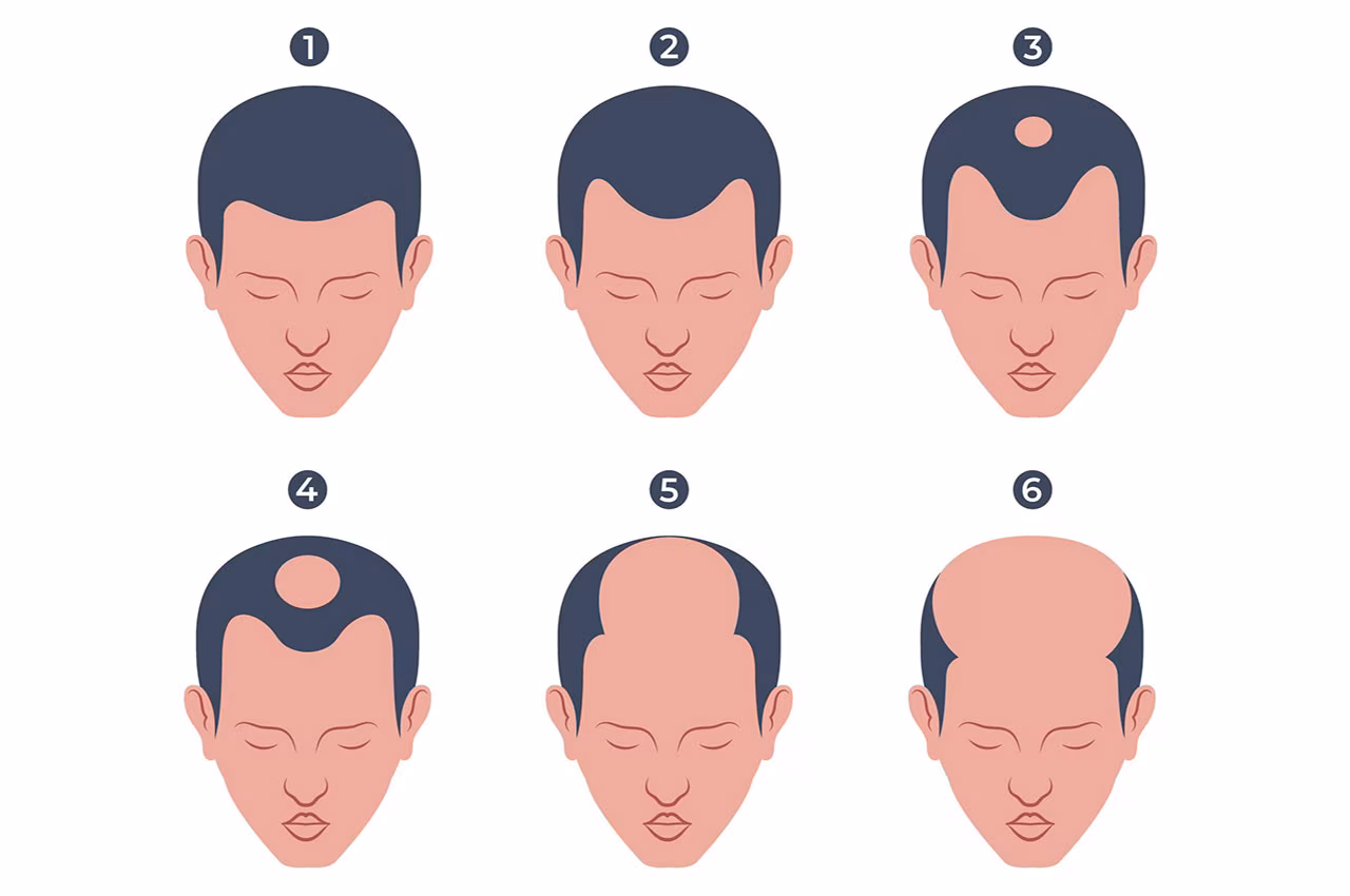 Alopecia Androgenética: Por que ela é a principal causa da calvície?